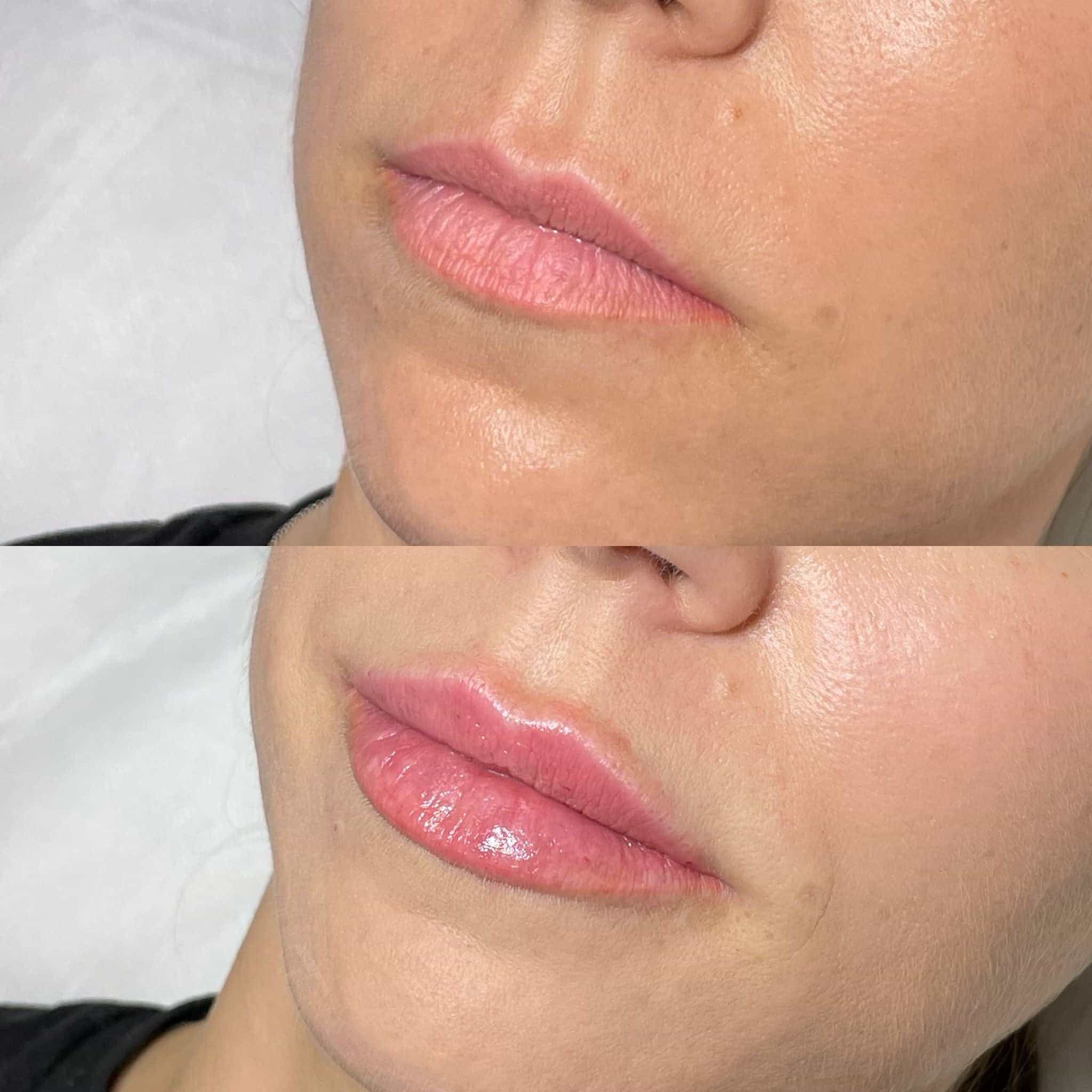 Before and after photos of lip filler treatment at It’s Me and You Clinic in London, Kingston upon Thames and Surrey – clear visual results of lip volume and contour improvement.