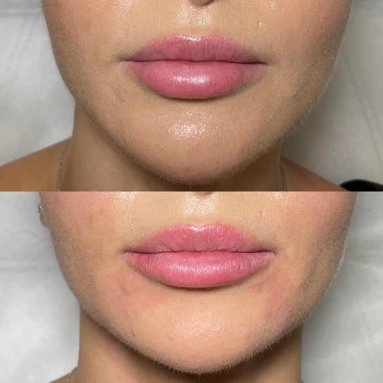 Botox Nefertiti Neck Lift in East Molesey, Surrey
