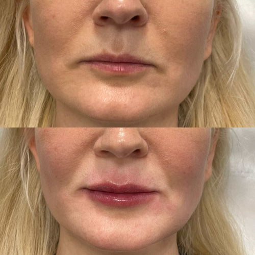 How Long Does Lip Filler Stay Swollen