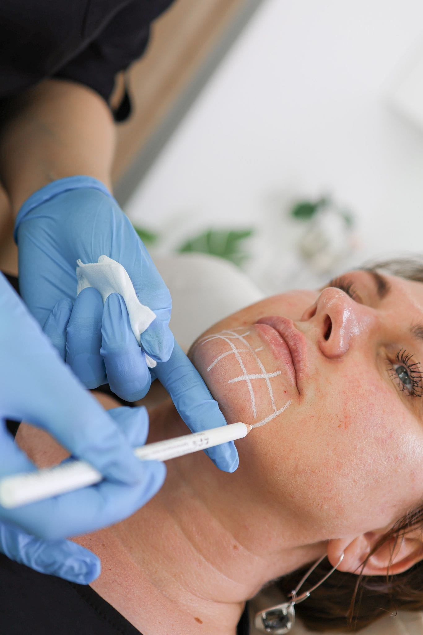 Botox Forehead Frown Lines in Dorking, Surrey