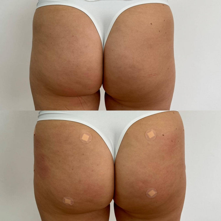 Botox Forehead Frown Lines in Twickenham, London