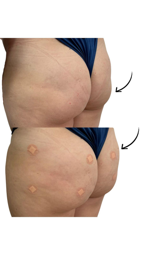 Non-Surgical Brazilian Bum Lift in Whyteleafe Surrey