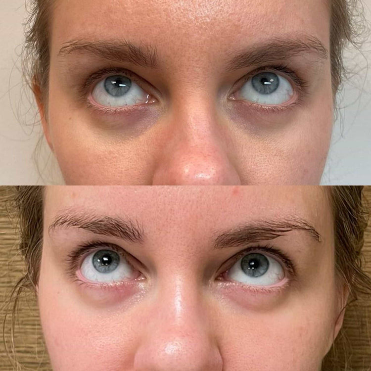 Botox For Under Eye Hollows in Farnham, Surrey