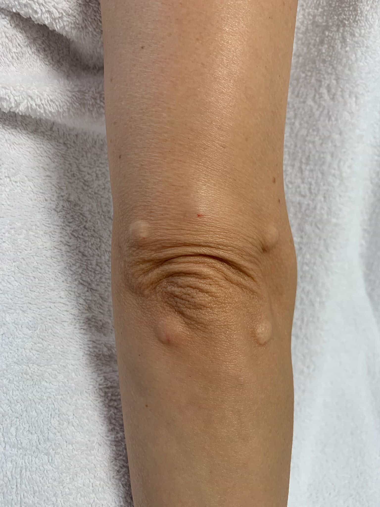 Botox for Dimpled Chin in Chertsey, Surrey