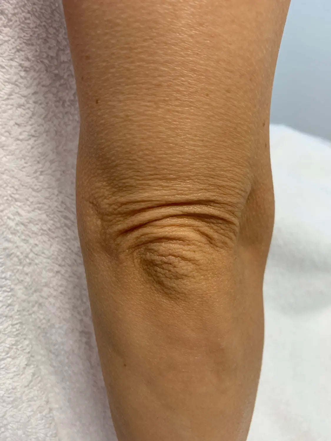 Profhilo Before And After