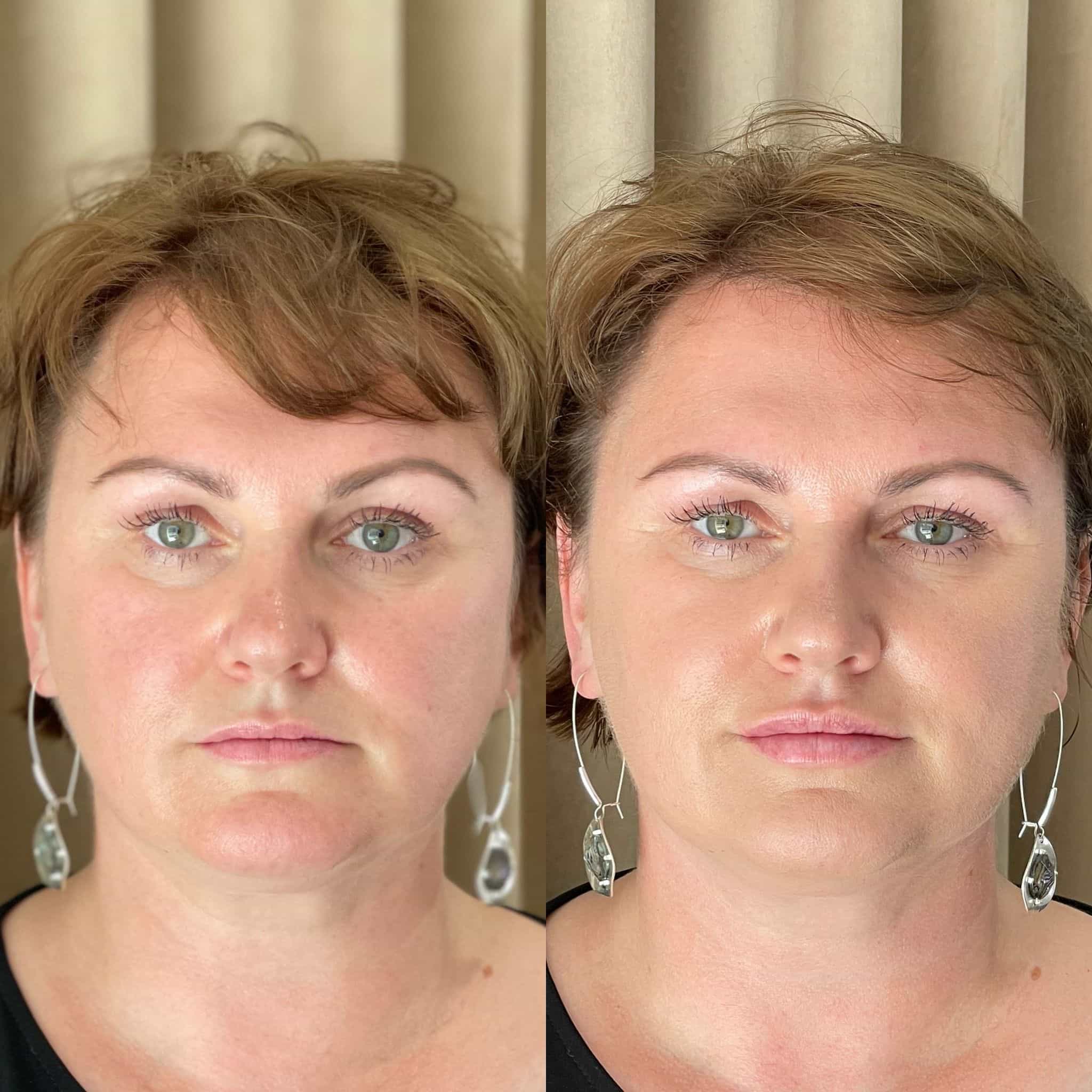 Skin Pen Microneedling - Kingston Upon Thames, Surrey, London – It's Me & You