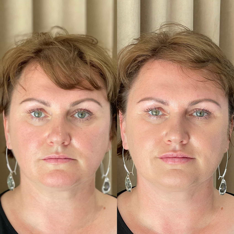 Acne Treatment Options in Salfords, Surrey
