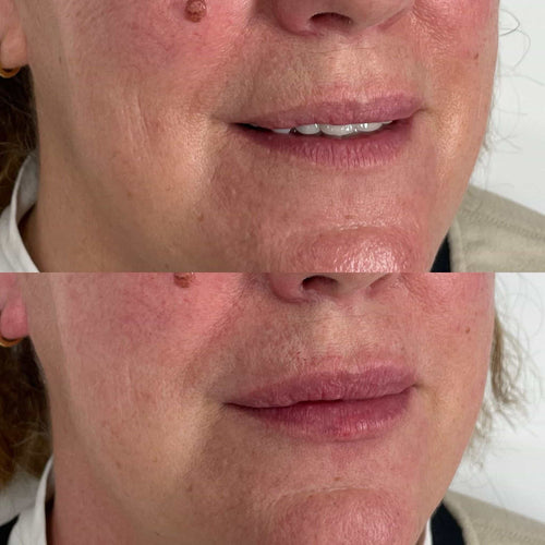 How many units of Botox does it take to tighten neck?