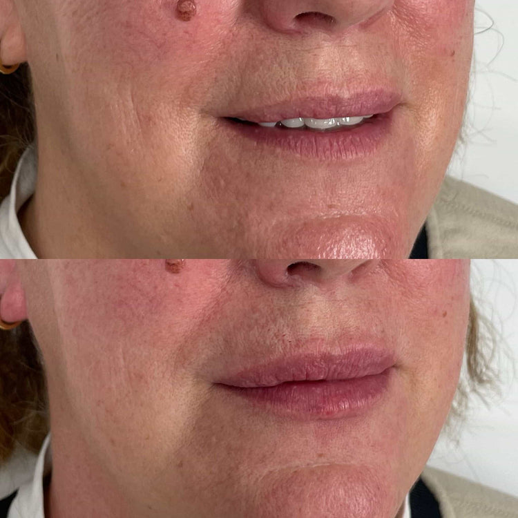 Non-Surgical Facial Fillers in Runnymede, Surrey