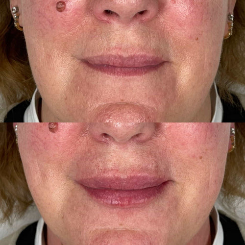 How long does the liquid face lift last?