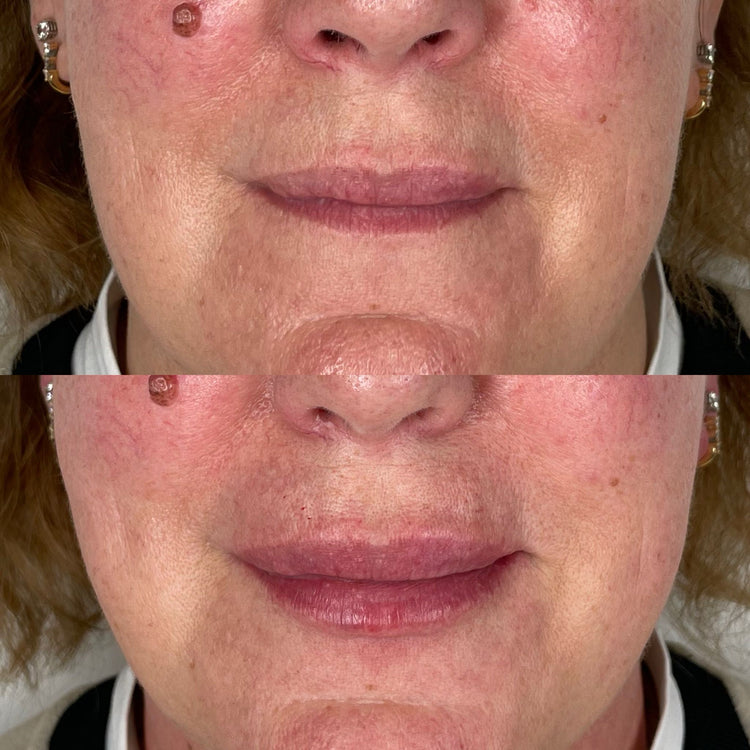 Botox Upper Face Wrinkles in Kensington, London
