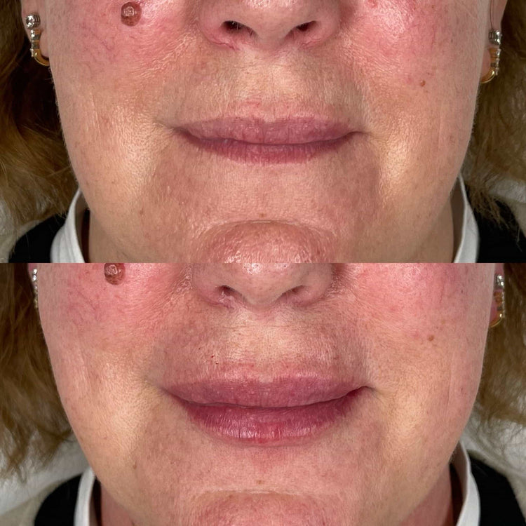 Non-Surgical Facial Fillers in Runnymede, Surrey