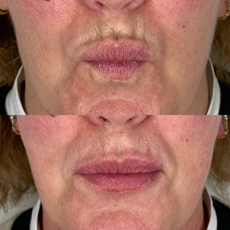 Dermal Fillers for Smile Lines: A Quick Solution for a Refreshed Look