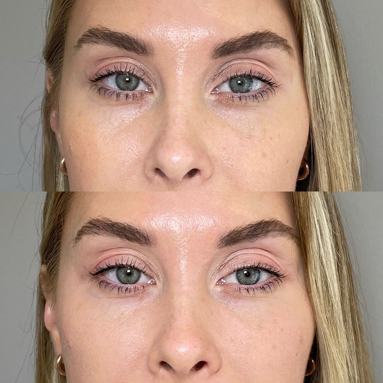 Botox Lip Flip in Twickenham, London