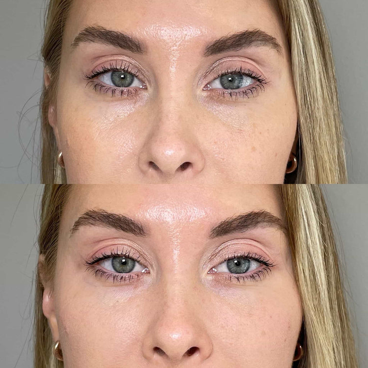 Non-Surgical Facial Fillers in Runnymede, Surrey