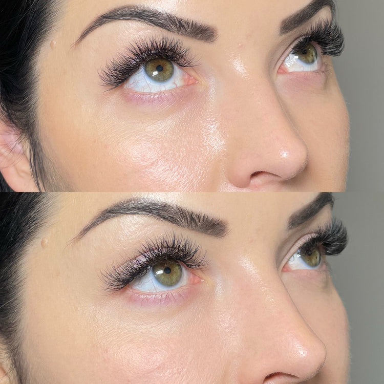 Botox Tinkerbell Nose Tip in Chertsey, Surrey