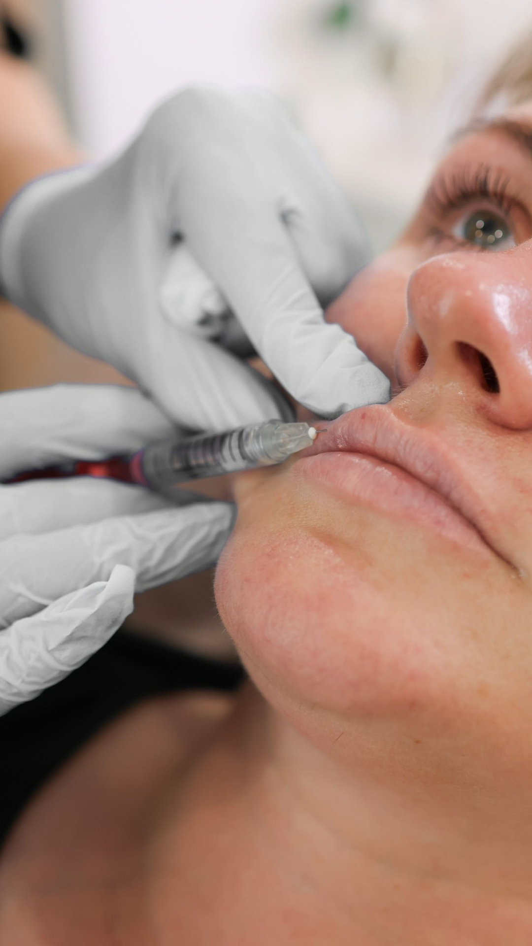 Lipstick lines treatment at It’s Me and You Clinic in London, Kingston upon Thames and Surrey – targeted lip line fillers, microneedling and anti-ageing treatments to reduce vertical mouth wrinkles.