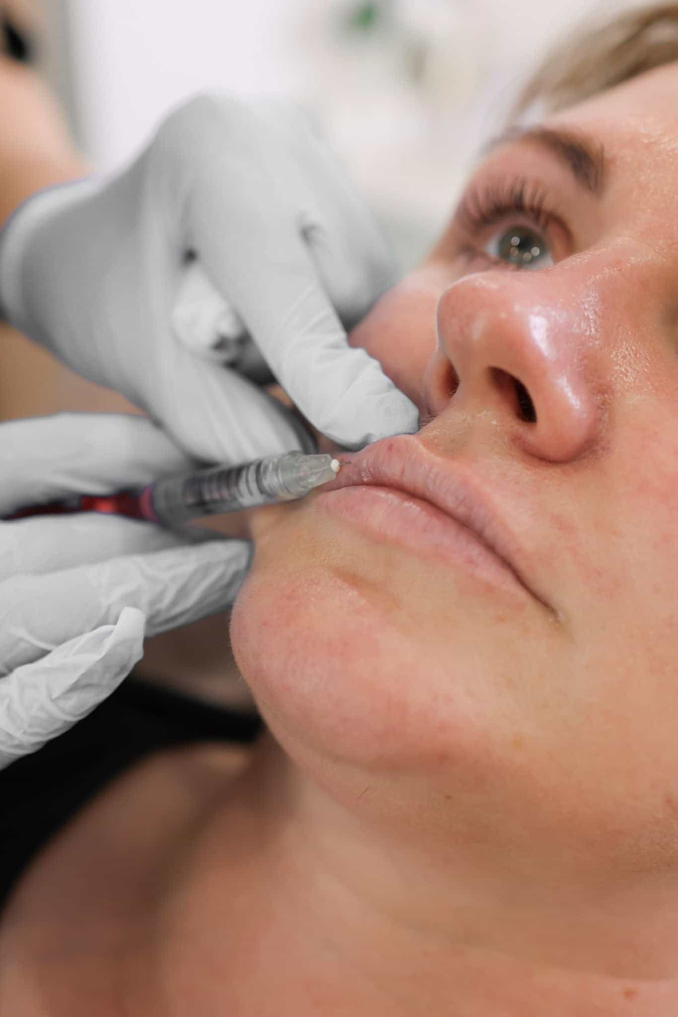 Thin and dry lips treatment at It’s Me and You Clinic in London, Kingston upon Thames and Surrey – lip enhancement with dermal fillers and hydration treatments to restore volume and smoothness.
