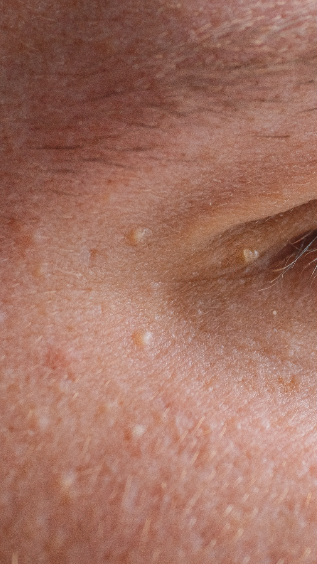 Milia treatment at It’s Me and You Clinic in London, Kingston upon Thames and Surrey – professional milia removal using extraction, chemical peels and targeted skincare solutions.