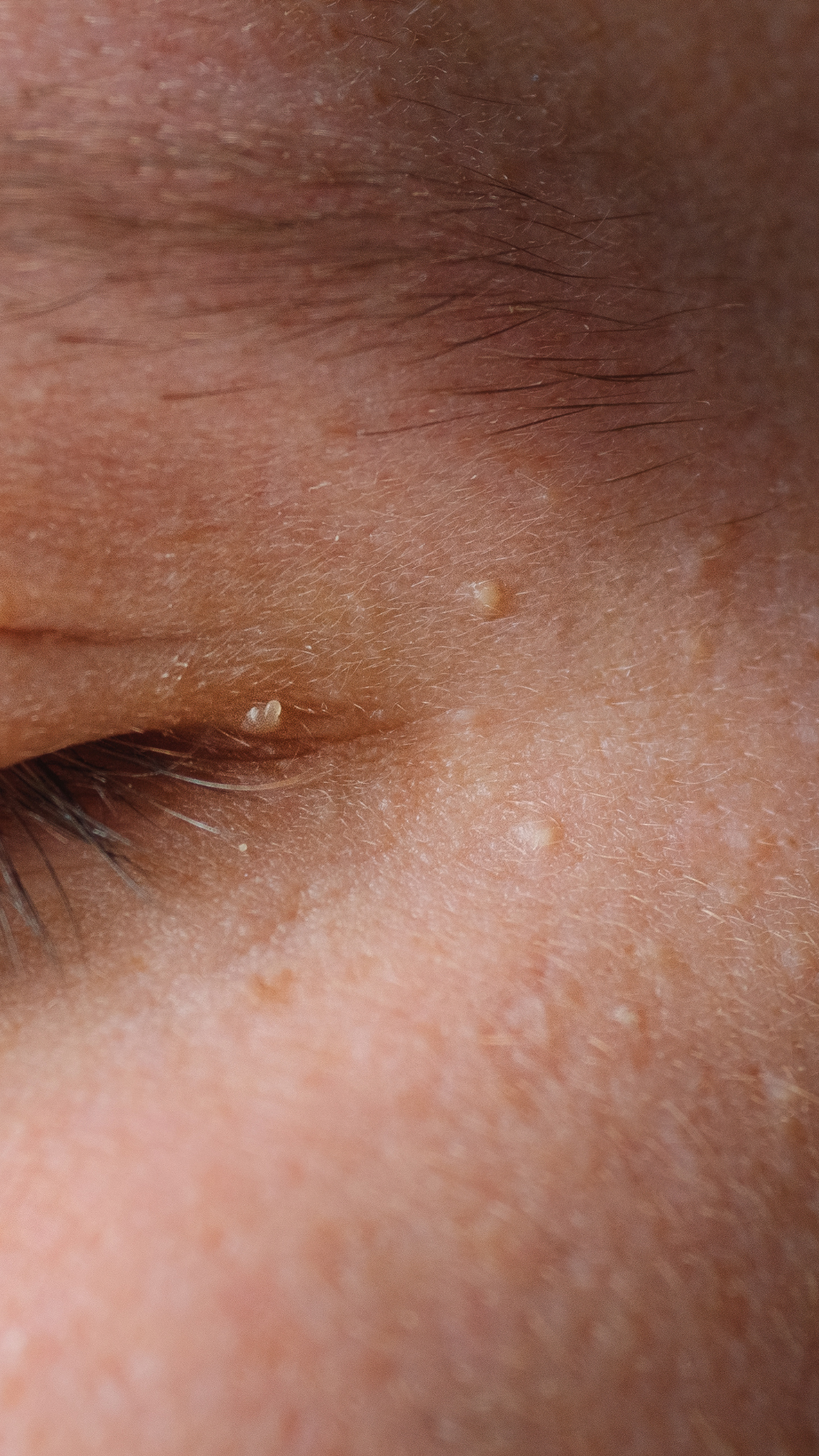 Milia treatment at It’s Me and You Clinic in London, Kingston upon Thames and Surrey – expert removal of milia using extraction, chemical peels and tailored skincare treatments.