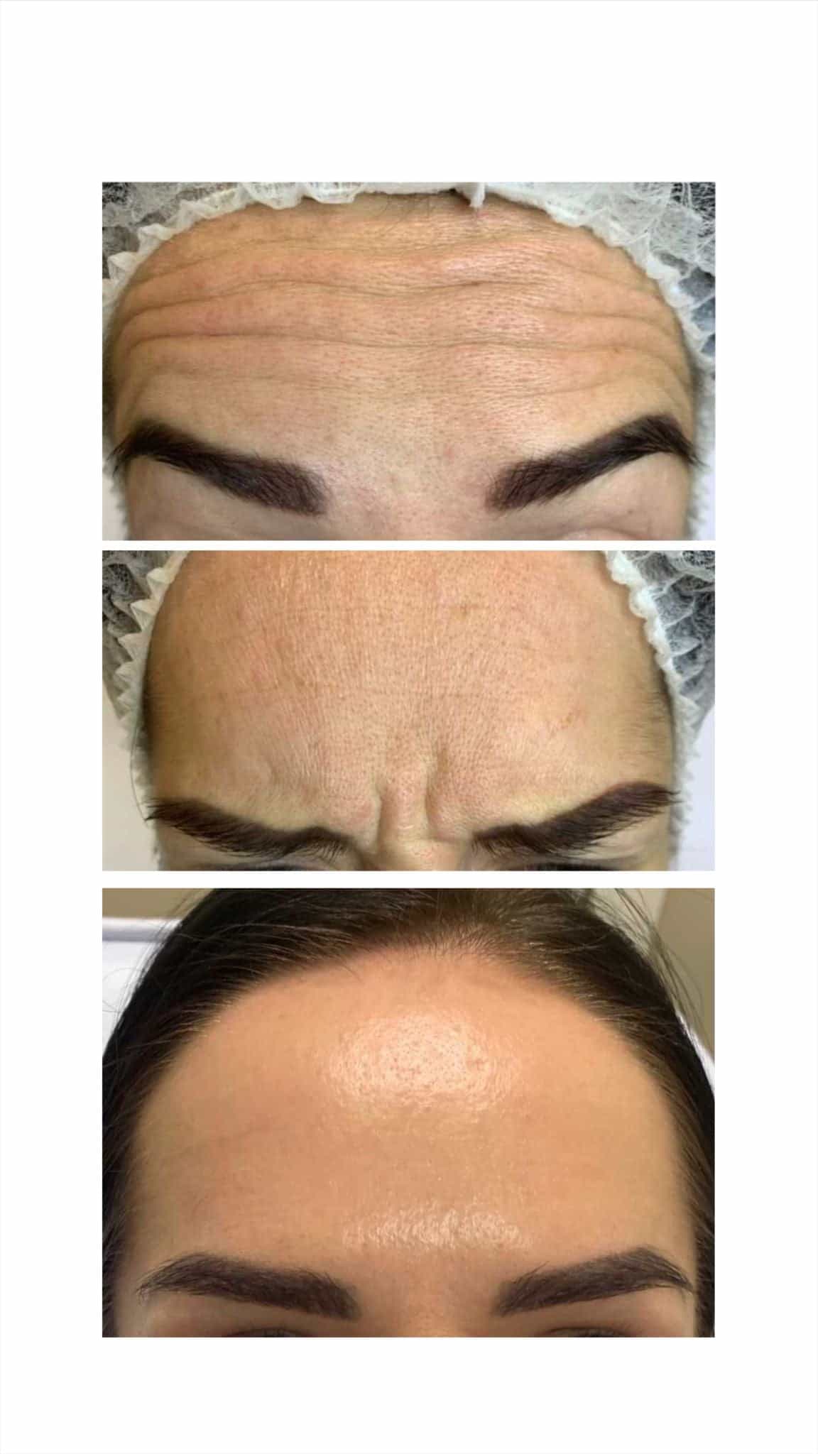Upper Face Anti-Wrinkle Injections - Kingston Upon Thames, Surrey, London – It's Me & You