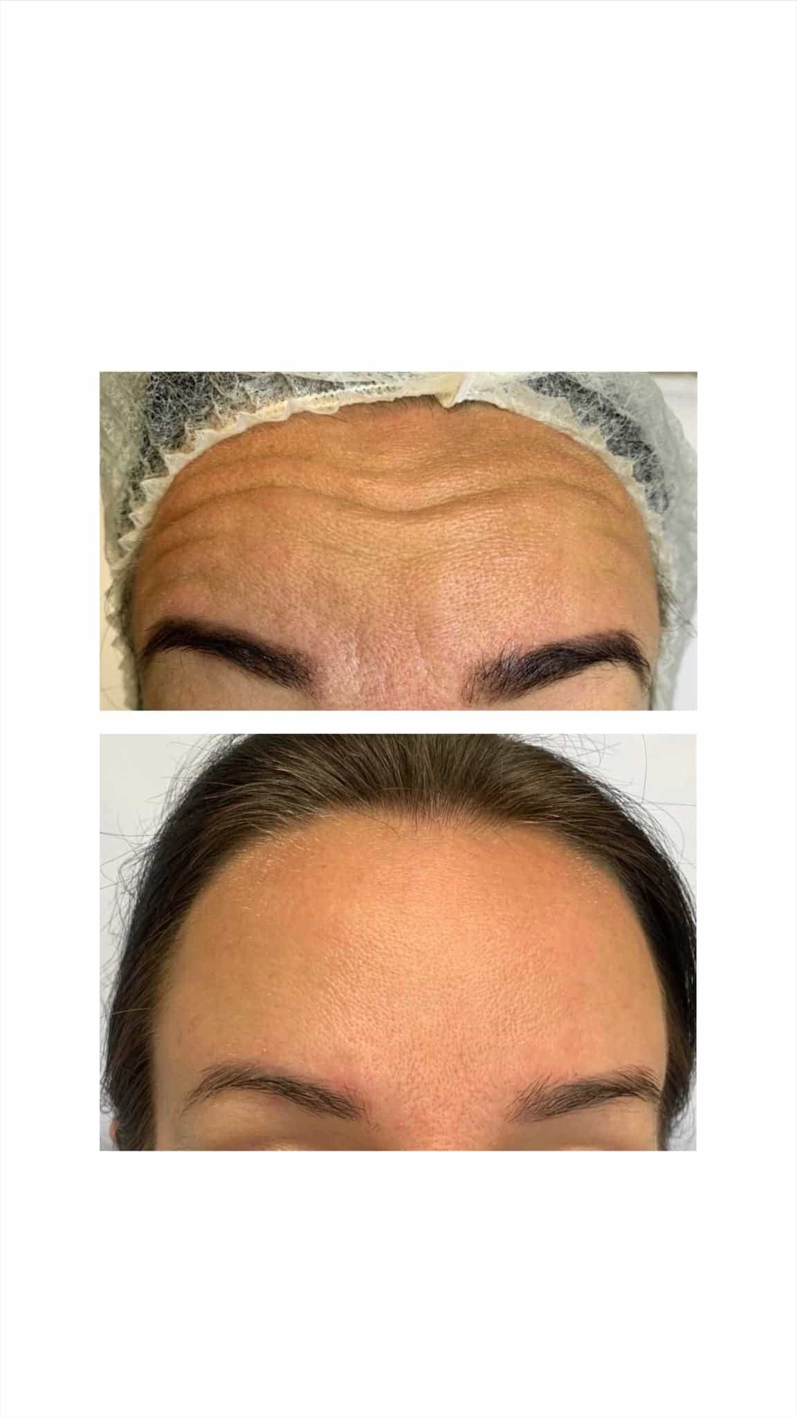 Upper Face Anti-Wrinkle Injections - Kingston Upon Thames, Surrey, London – It's Me & You