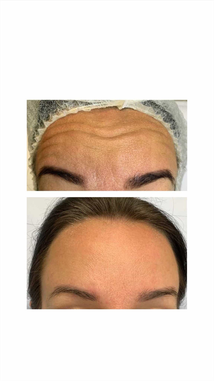Botox For Tired Eyes in Shere, Surrey