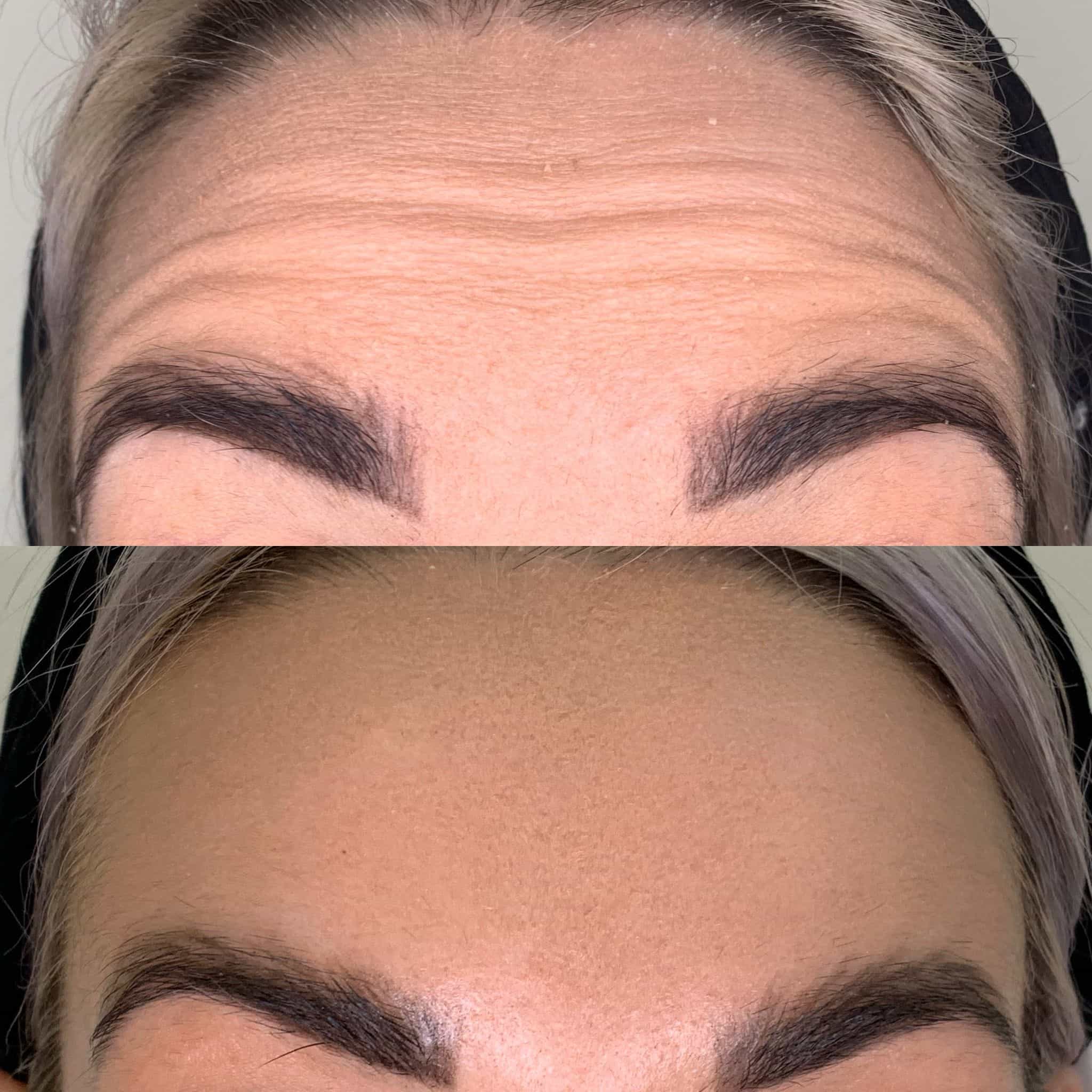 Upper Face Anti-Wrinkle Injections - Kingston Upon Thames, Surrey, London – It's Me & You