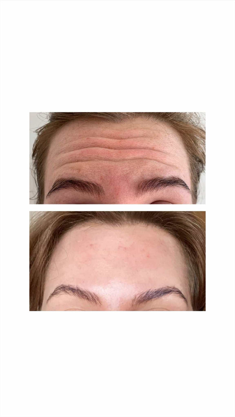 Acne Treatment Options in West Molesey, Surrey