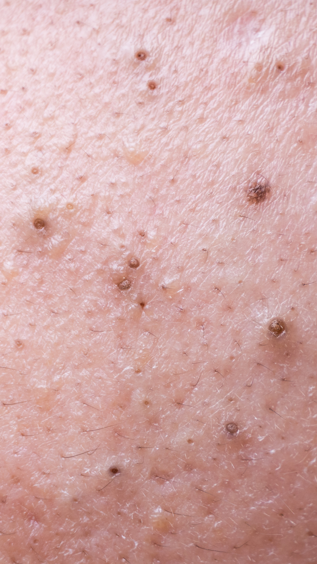 Blackheads Treatment in London & Kingston, Surrey – It's Me & You