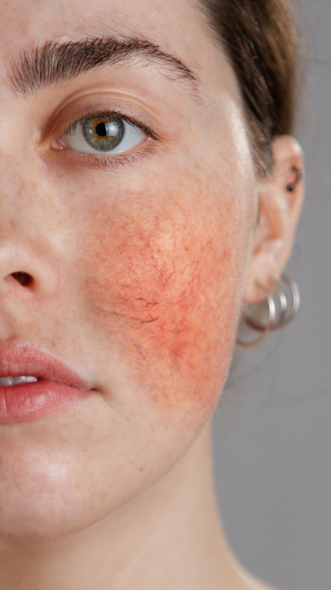Rosacea treatment at It’s Me and You Clinic in London, Kingston upon Thames and Surrey – IPL therapy, LED light treatment and calming skincare to reduce redness, inflammation and flare-ups.