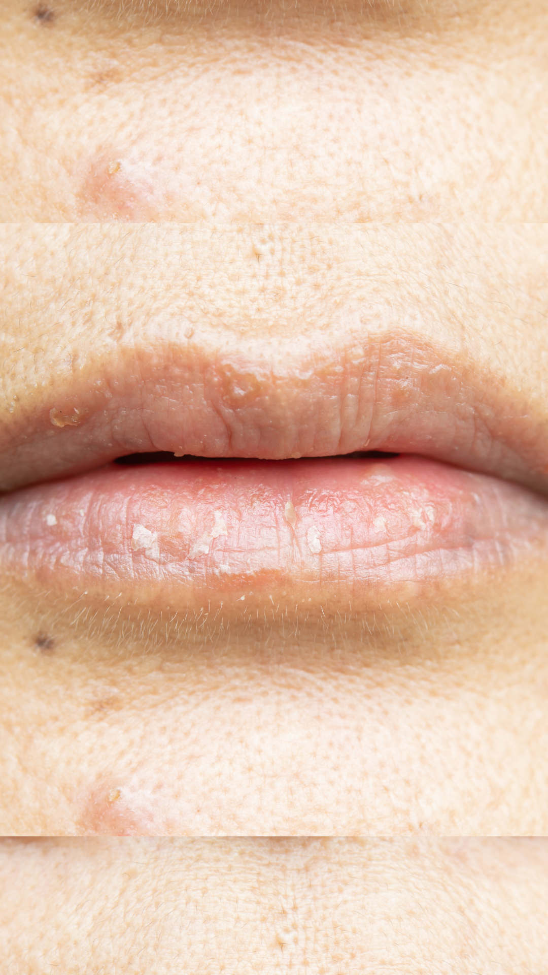 Tired eyes treatment at It’s Me and You Clinic in London, Kingston upon Thames and Surrey – tear trough fillers, Ultherapy and microneedling for dark circles, eye bags and under-eye hollows.