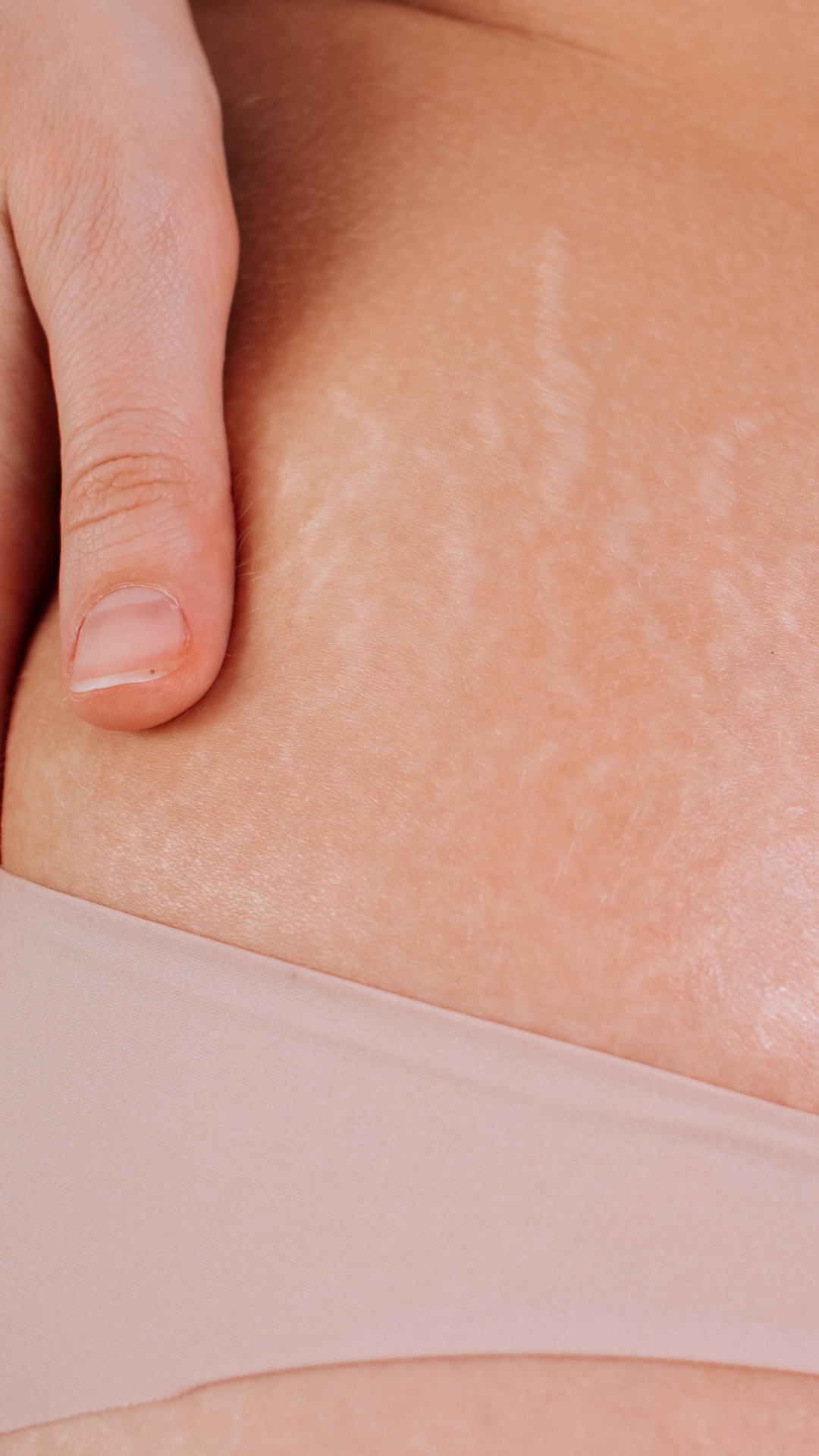 Stretch mark treatments at It’s Me and You Clinic in London, Kingston upon Thames and Surrey – microneedling, laser therapy and skin boosters to reduce stretch marks and improve skin texture.