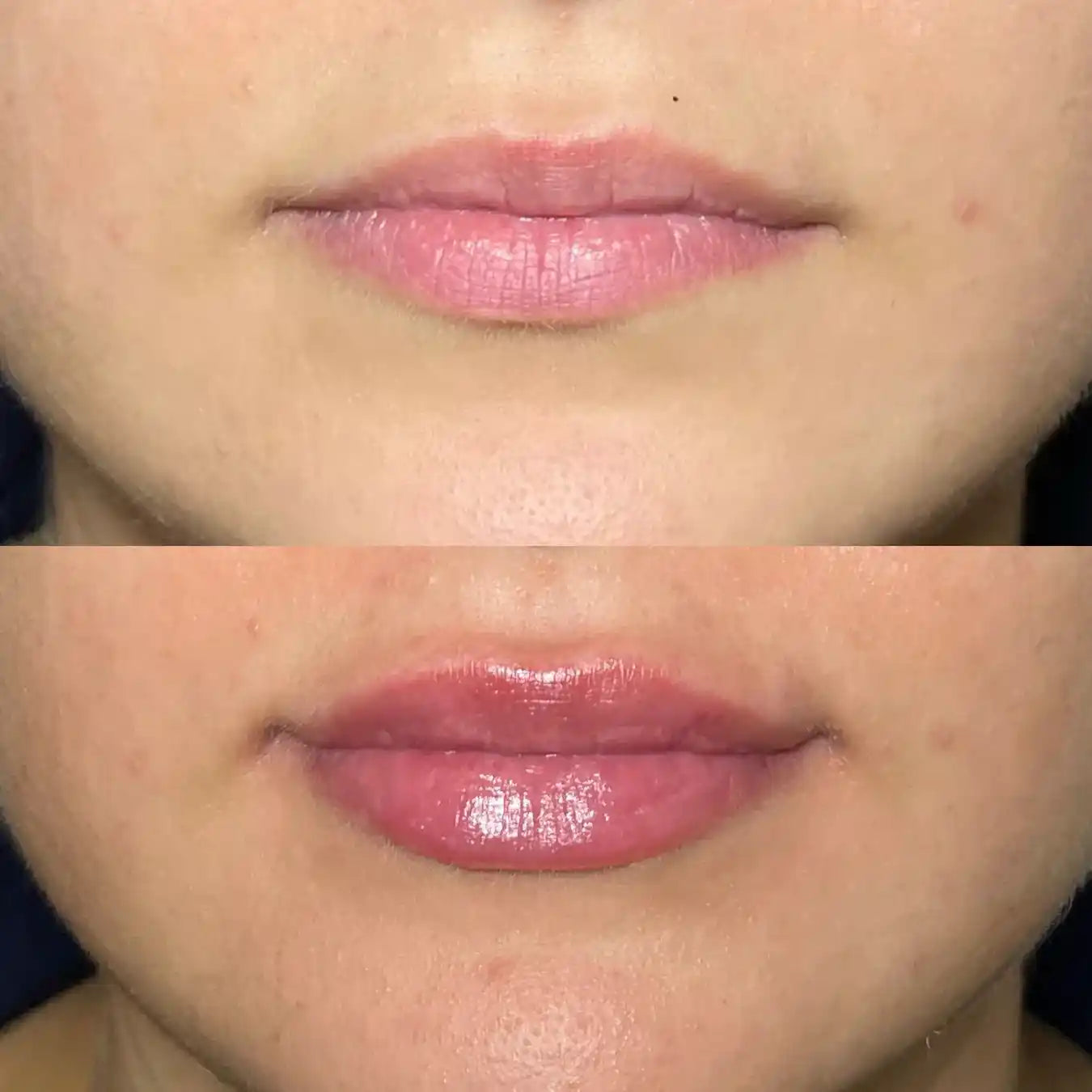 Thin lips fillers at It’s Me and You Clinic in London, Kingston upon Thames and Surrey – lip filler injections for natural volume, definition and enhanced shape.