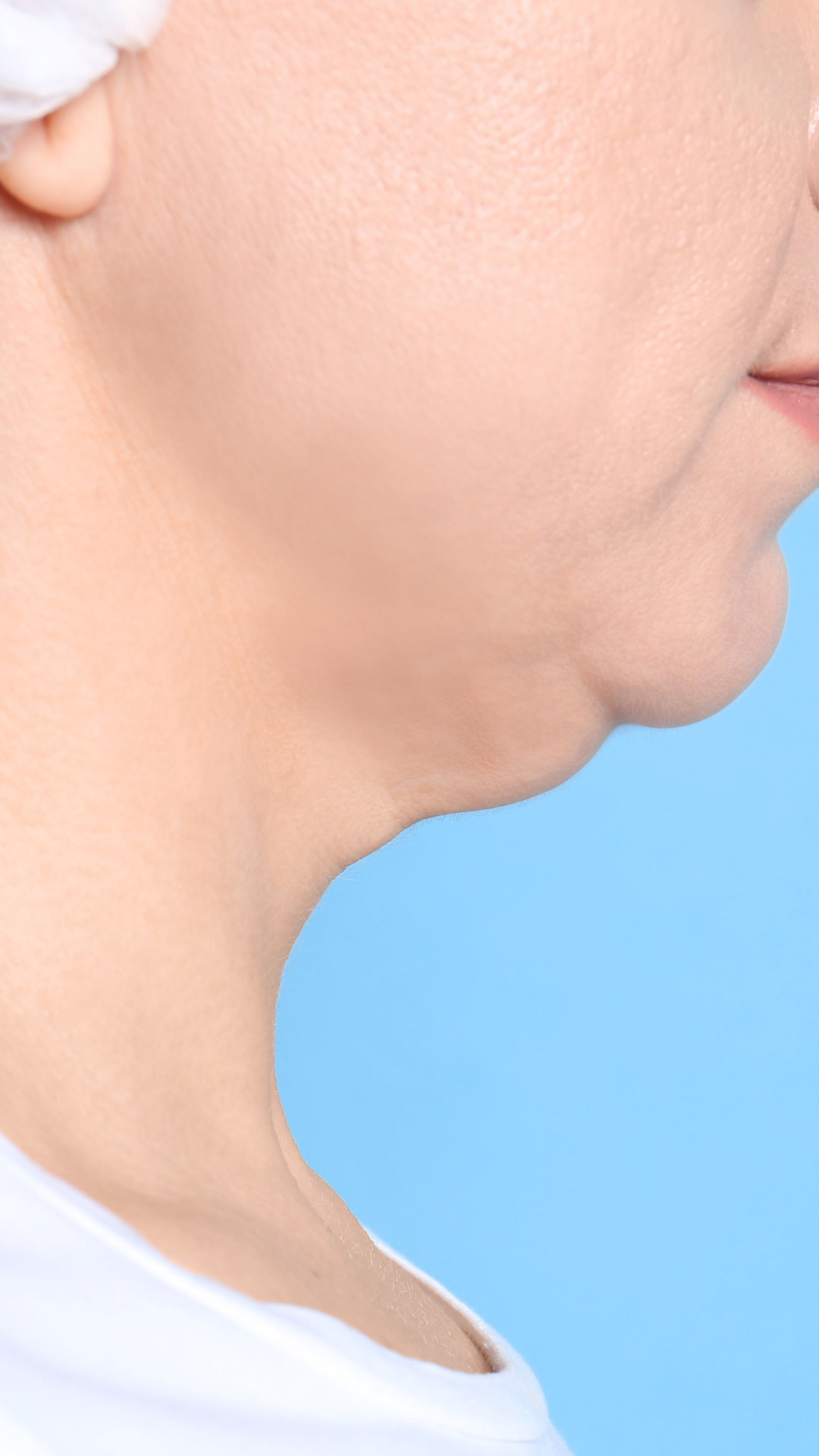 Double Chin Removal, Non surgical Double Chin Treatments in London & K – It's Me & You
