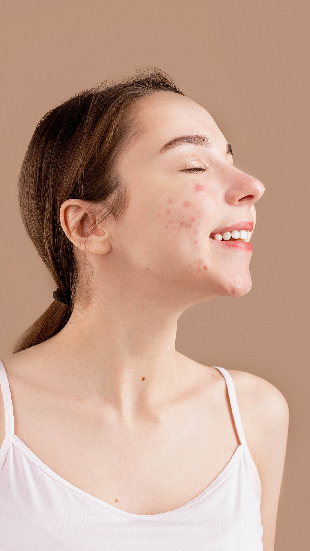 Acne treatment at It’s Me and You Clinic in London, Kingston upon Thames and Surrey – personalised skincare, chemical peels, LED light therapy and microneedling to treat active acne and prevent breakouts.