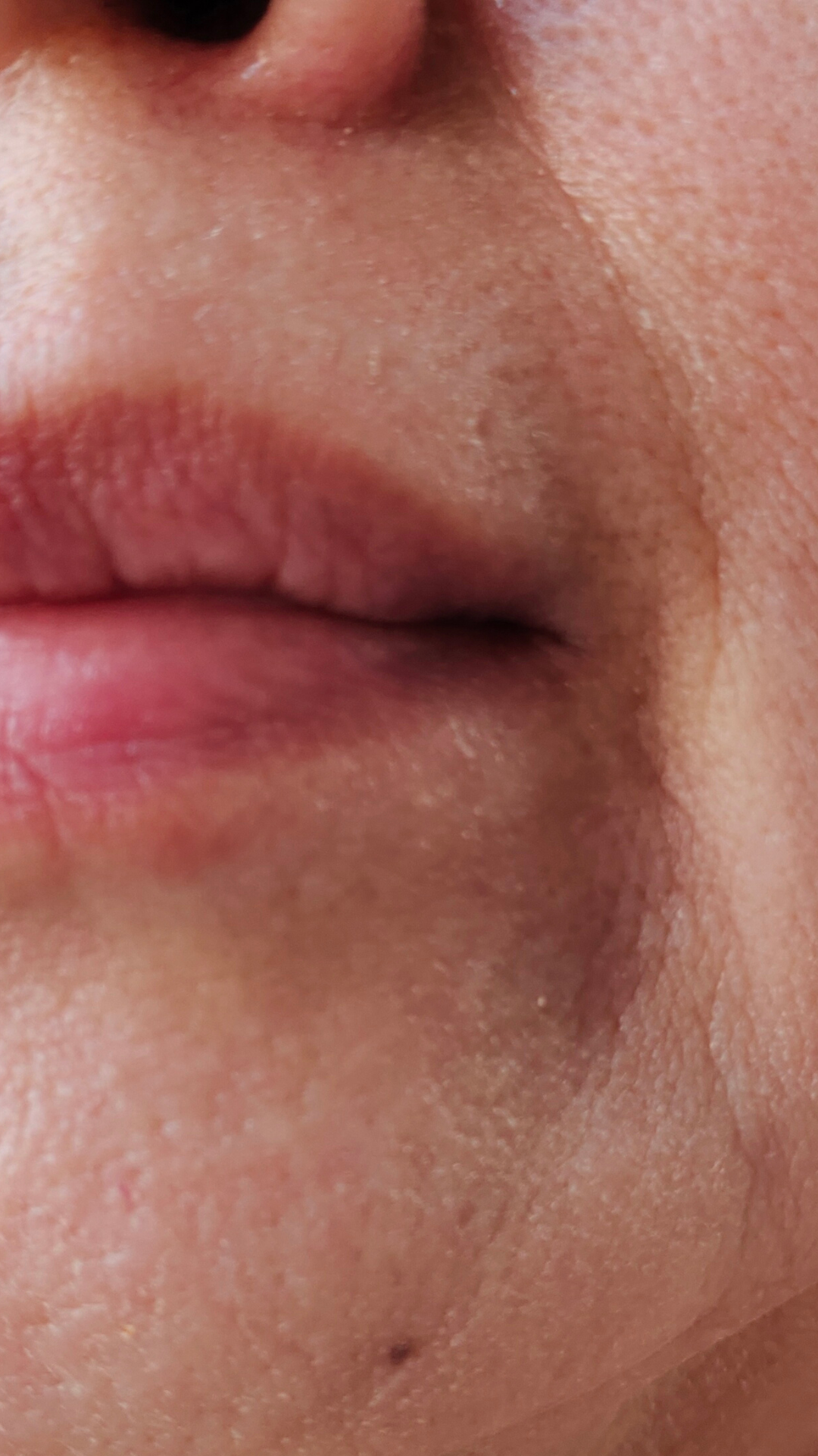 Nose to mouth lines treatment at It’s Me and You Clinic in London, Kingston upon Thames and Surrey – dermal fillers for nasolabial folds and non-surgical wrinkle correction.