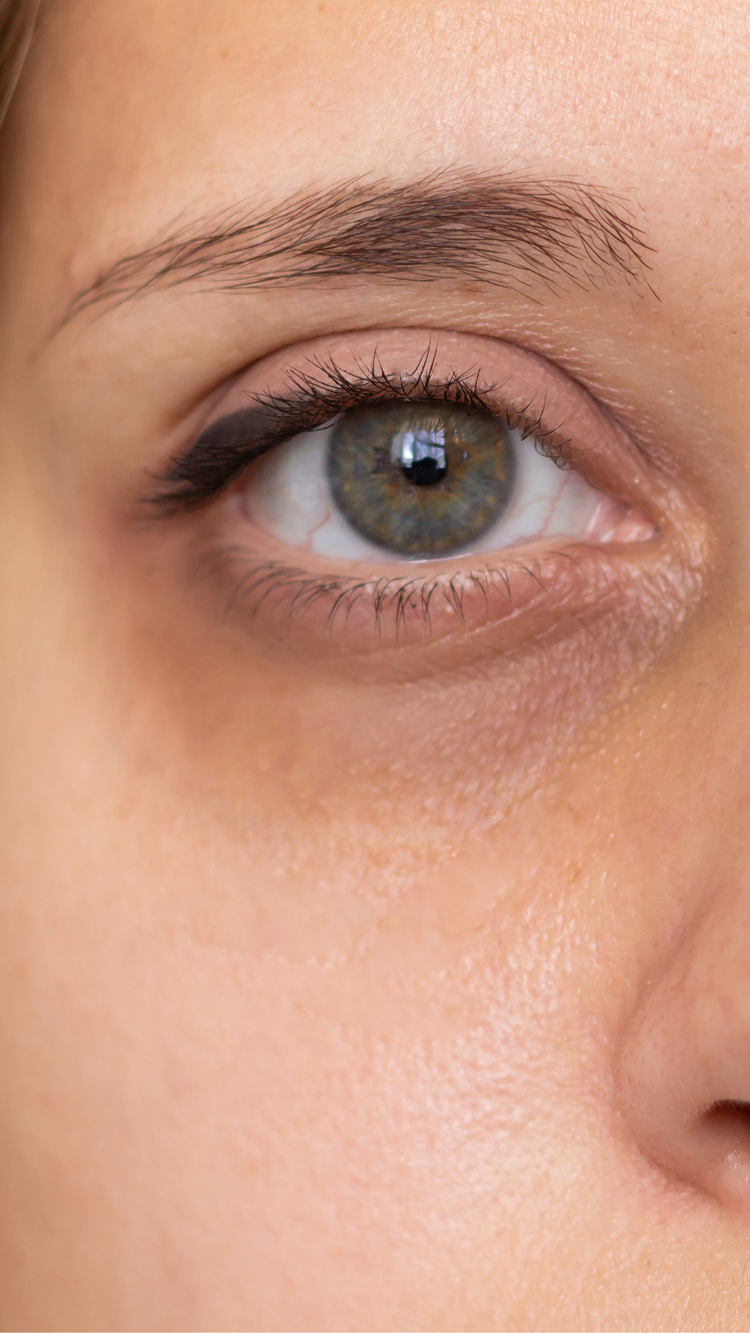 Dark Circles Under Eyes in London & Kingston, Surrey – It's Me & You