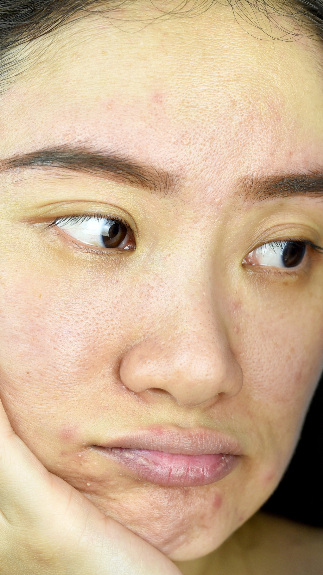 Dull Skin Treatment in London & Kingston, Surrey – It's Me & You