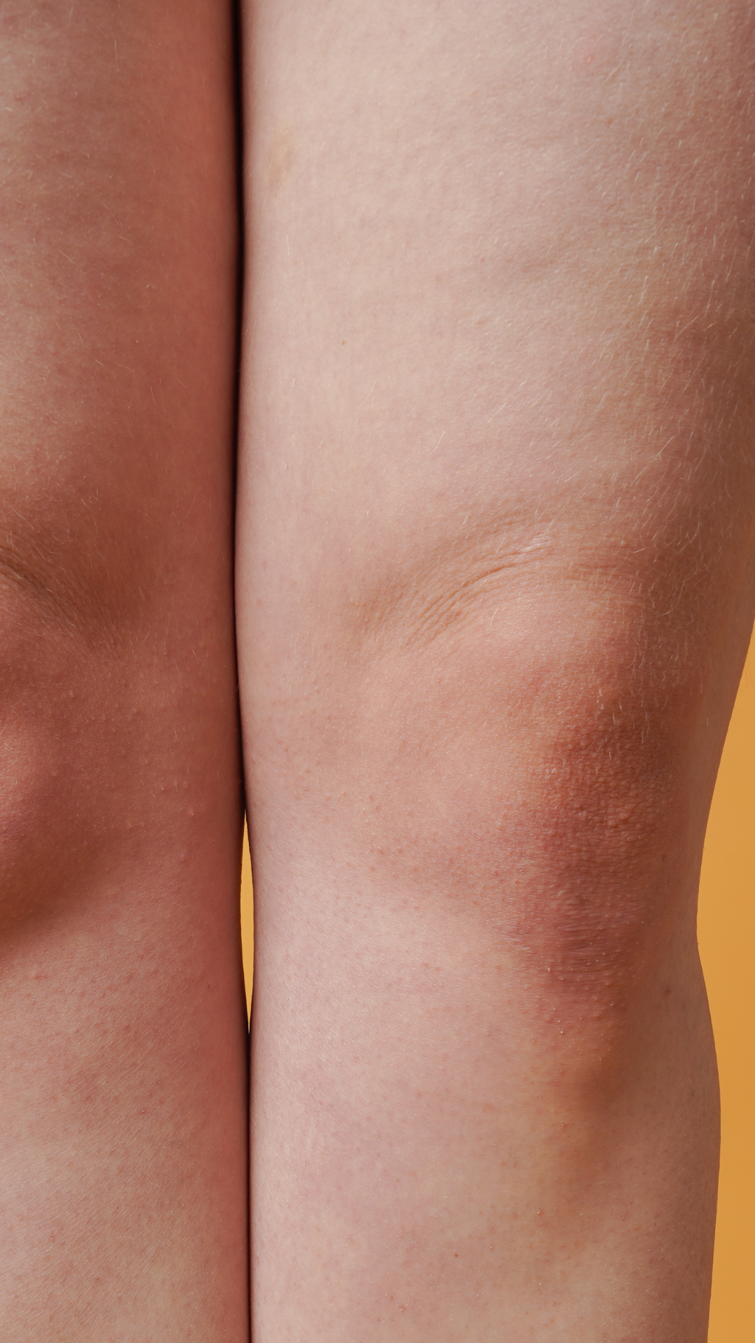 Knee Fat Treatment in London & Kingston, Surrey – It's Me & You