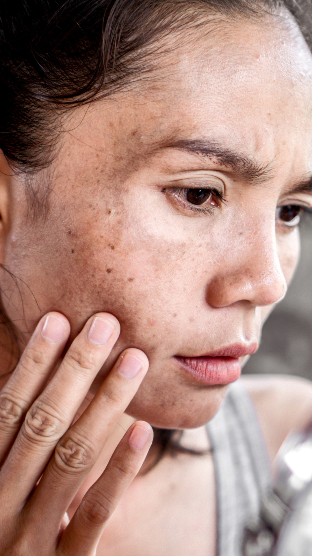 Uneven skin tone treatment at It’s Me and You Clinic in London, Kingston upon Thames and Surrey – advanced solutions to brighten complexion, even out pigmentation, and restore radiant skin.