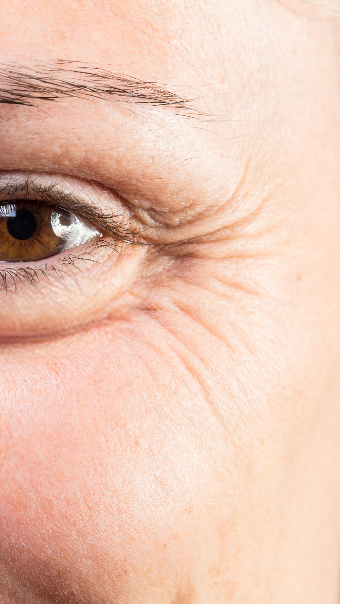 Crow's Feet Treatment in London & Kingston, Surrey – It's Me & You