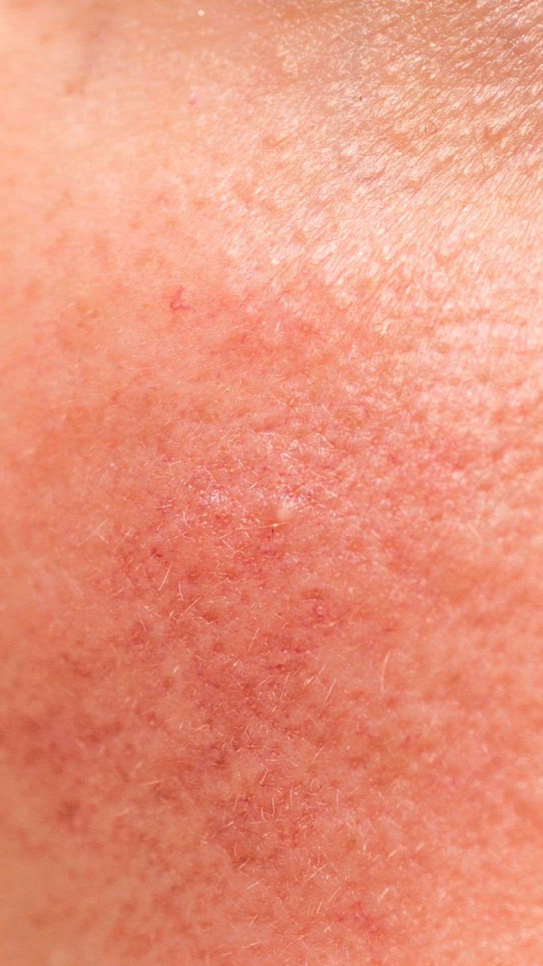 Redness treatment at It’s Me and You Clinic in London, Kingston upon Thames and Surrey – laser therapy, LED light treatment and skincare solutions for facial redness, rosacea and irritation.