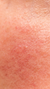 Redness Treatment in London & Kingston, Surrey – It's Me & You
