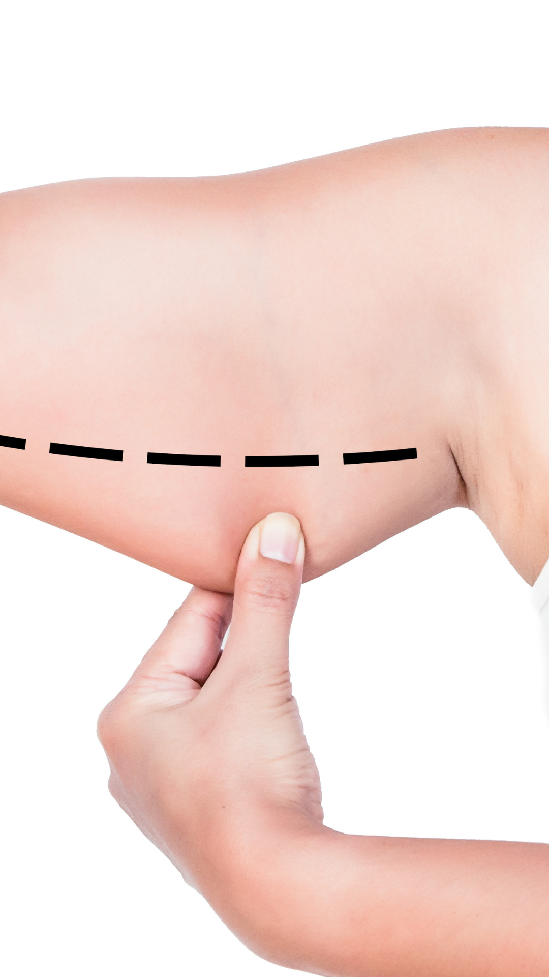Lose Arm Fat with CoolSculpting in London & Kingston, Surrey | Non sur – It's Me & You