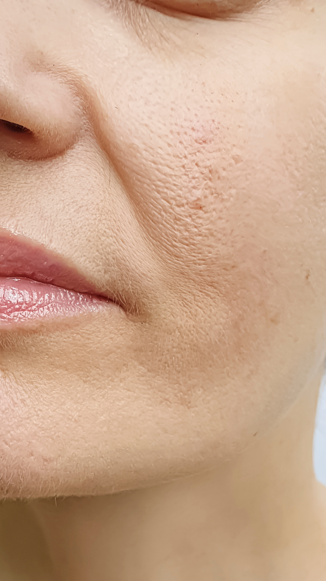 Nose to mouth lines treatment – It’s Me & You Clinic Kingston upon Thames, Surrey, London