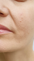 Best Nose to Mouth Lines Treatments in London & Kingston, Surrey – It's Me & You