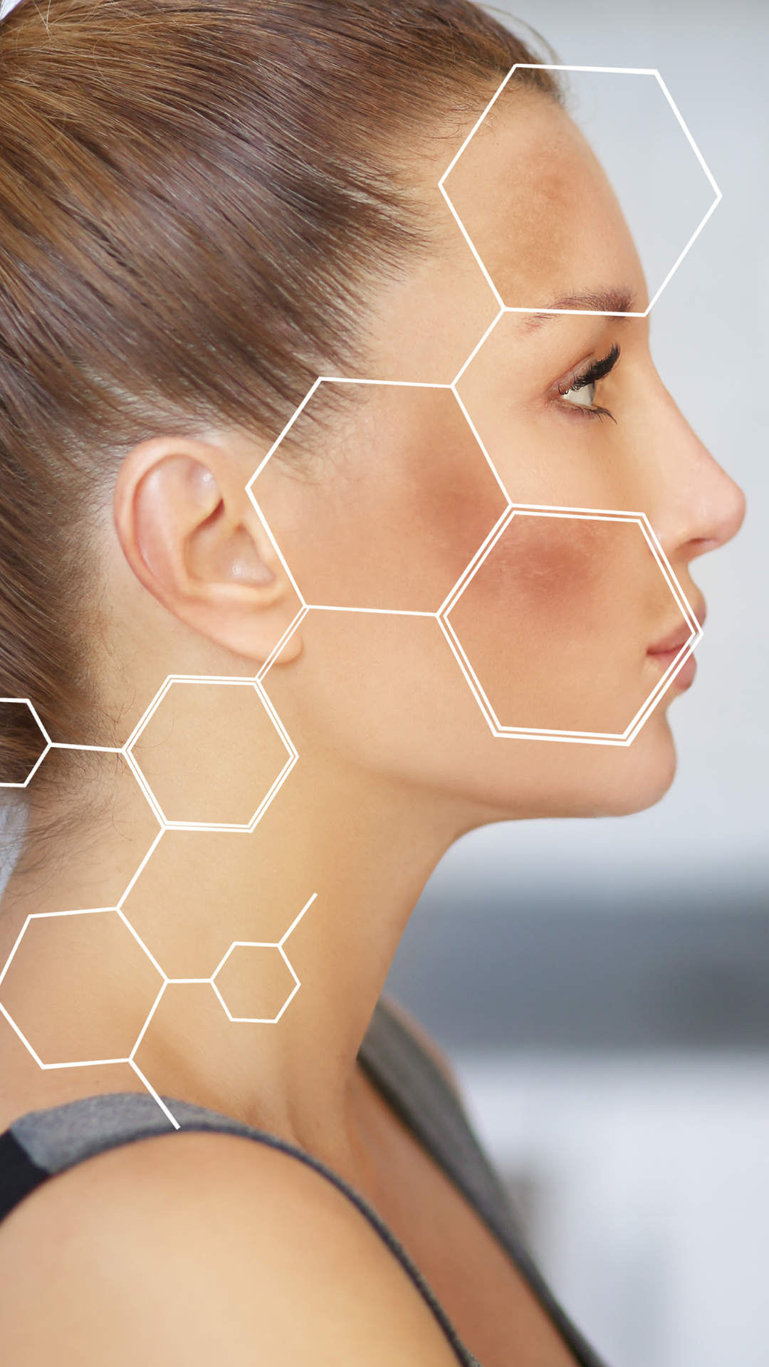 Hyperpigmentation treatment at It’s Me and You Clinic in London, Kingston upon Thames and Surrey – chemical peels, laser therapy and microneedling to reduce dark spots, sun damage and uneven skin tone.