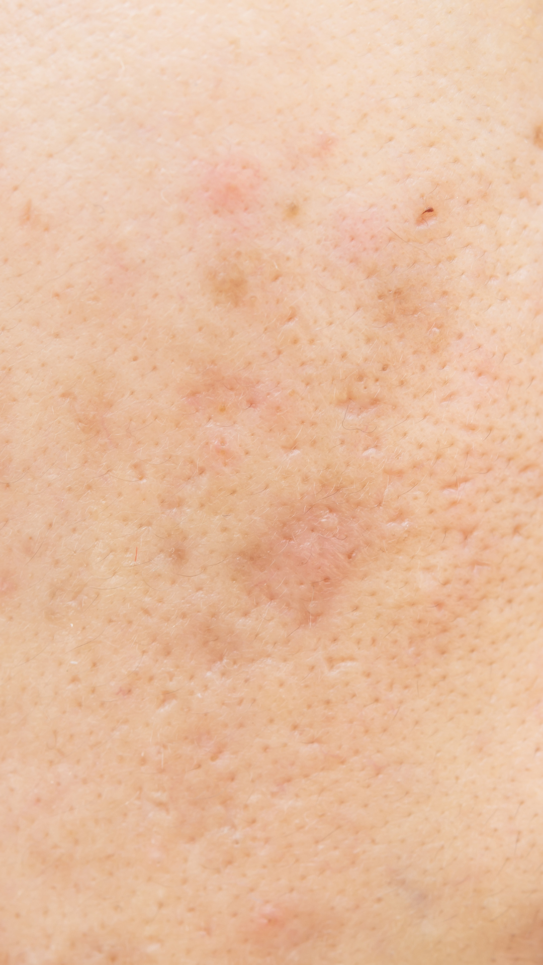 Age spots and cheek pigmentation treatment – It’s Me & You Clinic Kingston upon Thames, Surrey, London