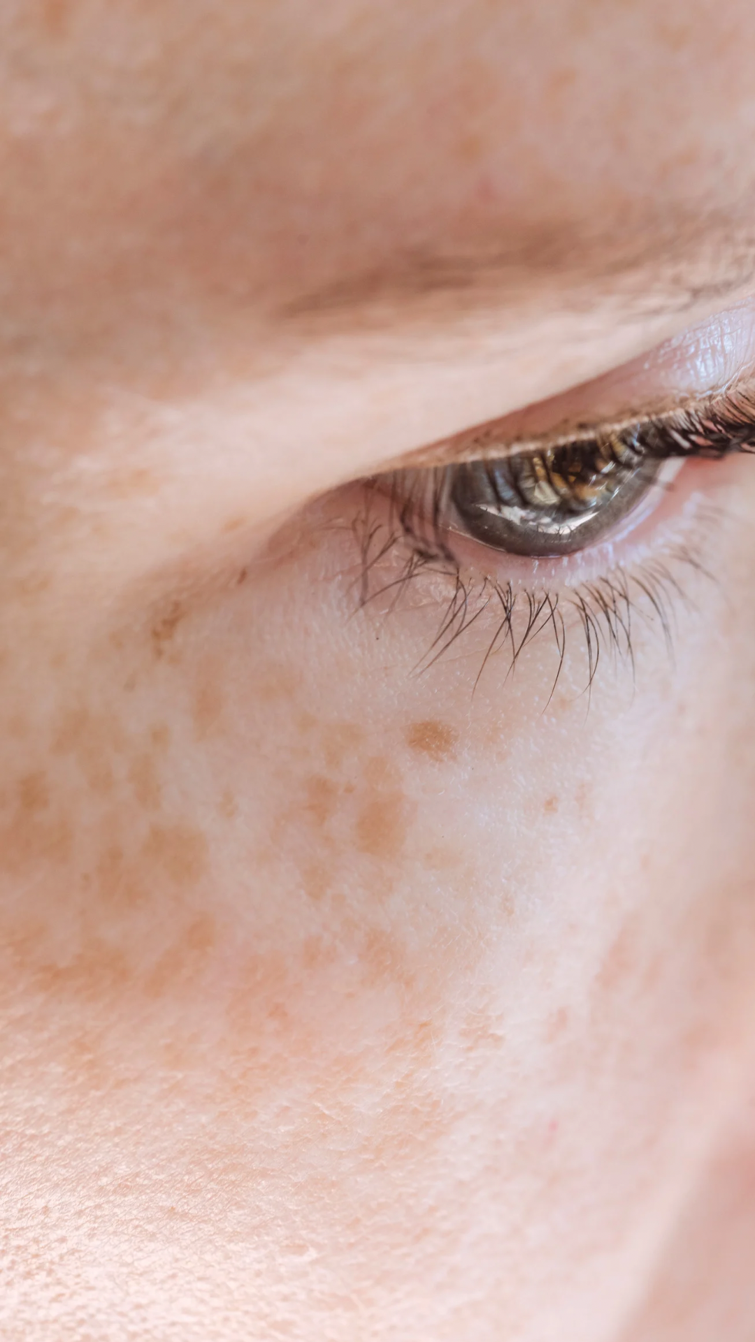 Pigmentation treatment at It’s Me and You Clinic in London, Kingston upon Thames and Surrey – laser treatment, chemical peels and microneedling to reduce dark spots, melasma and uneven skin tone.